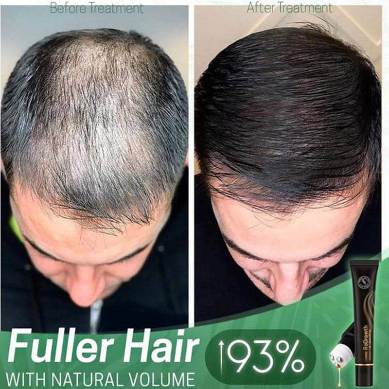 Repair Hair® | Óleo de Crescimento Capilar - Diminui Queda 95% e Aumenta Crescimento